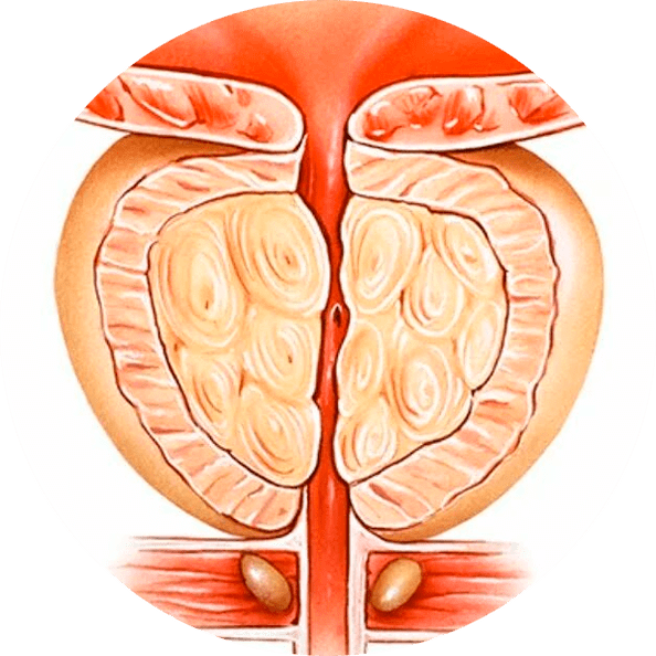 Consecințele prostatitei netratate