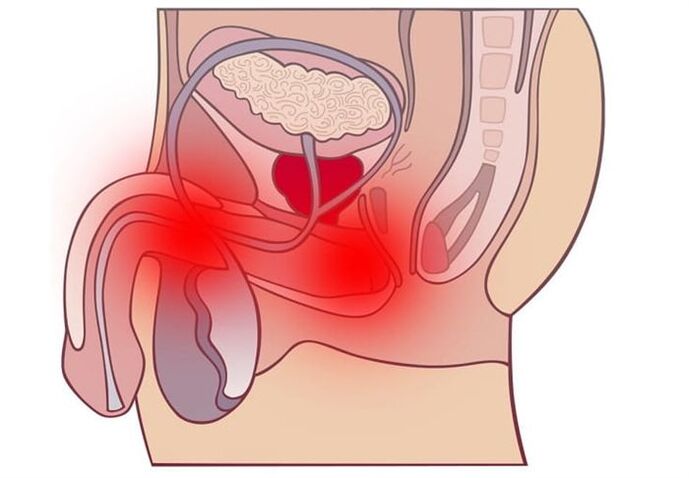 metode de tratare a prostatitei