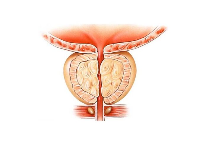 tratamentul prostatitei cu remedii populare