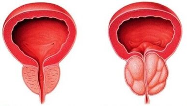 prostată sănătoasă și inflamată cu prostatita